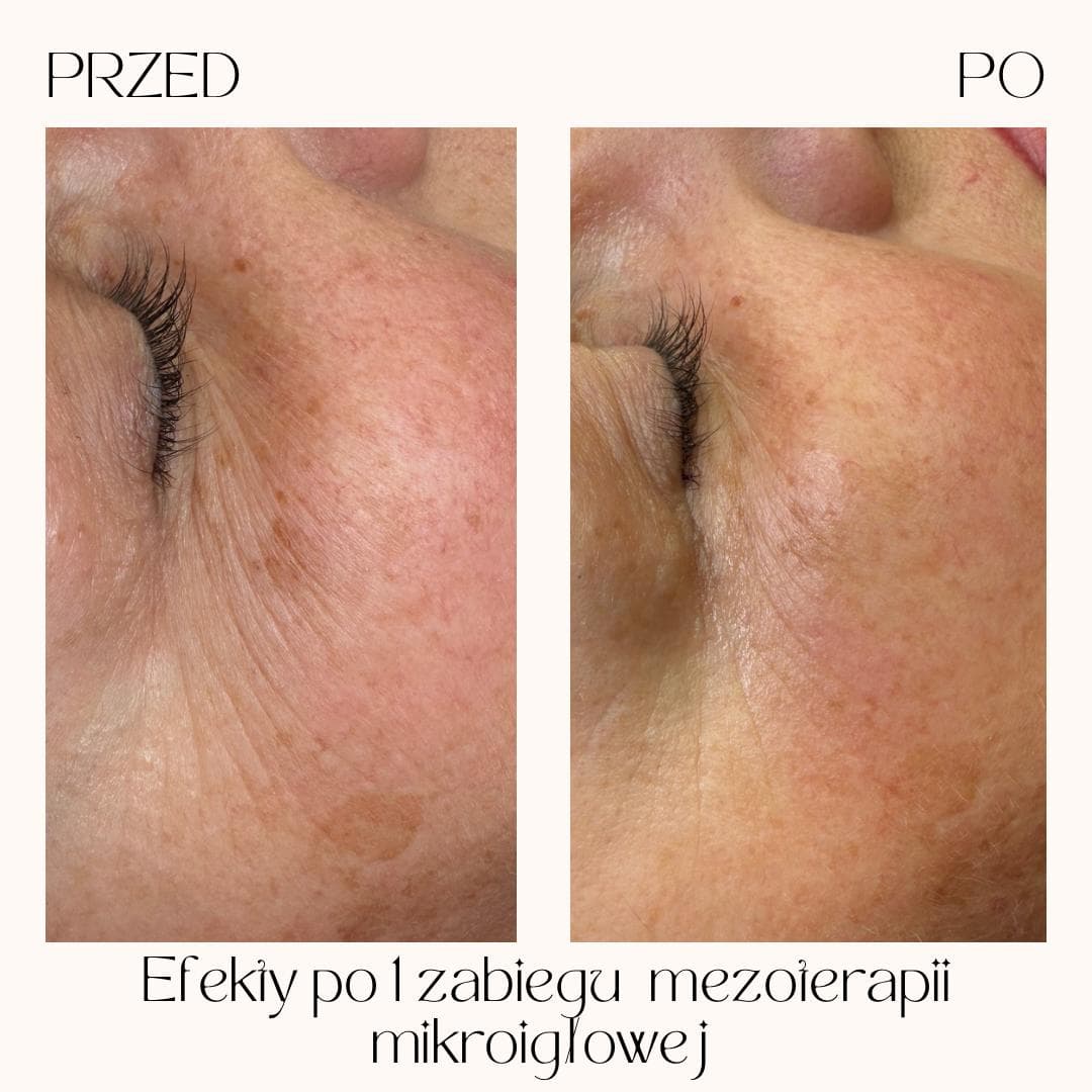 Efekty zabiegów Clean Skin — zdjęcie 1
