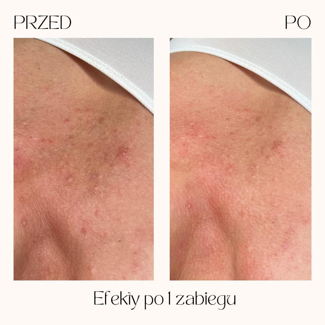Efekty zabiegów Clean Skin — zdjęcie 2