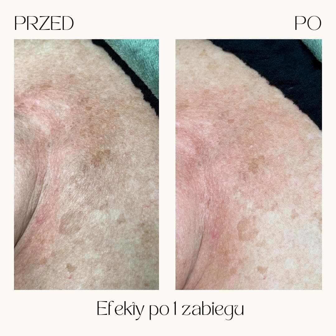 Efekty zabiegów Clean Skin — zdjęcie 3