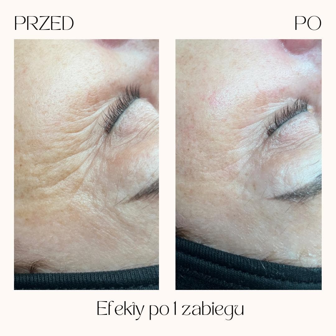 Efekty zabiegów Clean Skin — zdjęcie 4