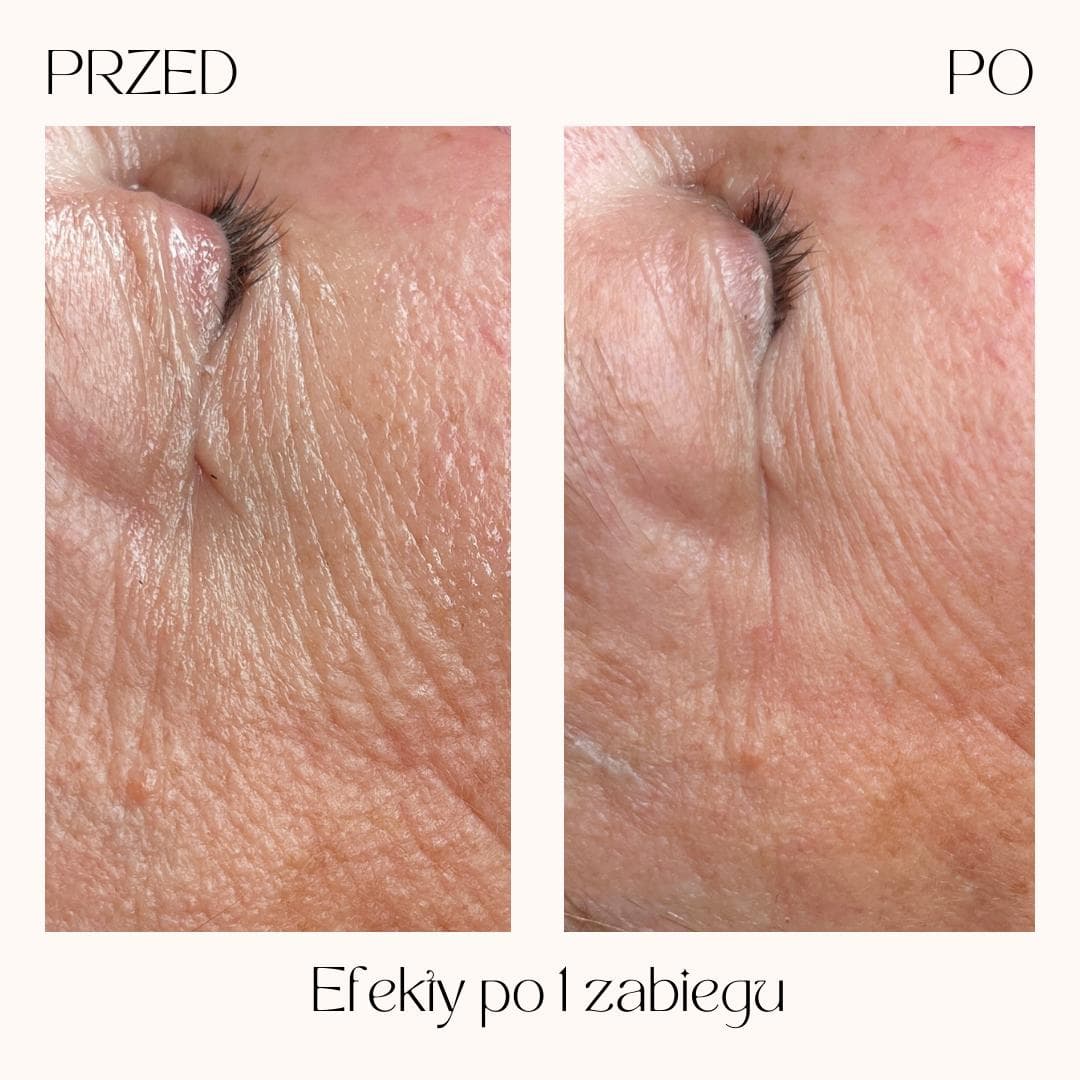 Efekty zabiegów Clean Skin — zdjęcie 5