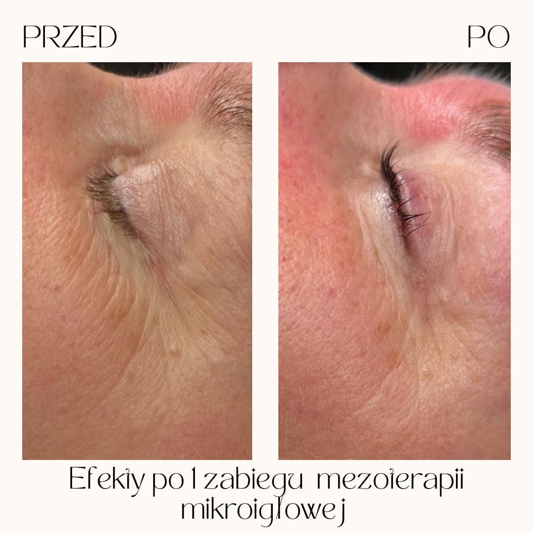 Efekty zabiegów Clean Skin — zdjęcie 6