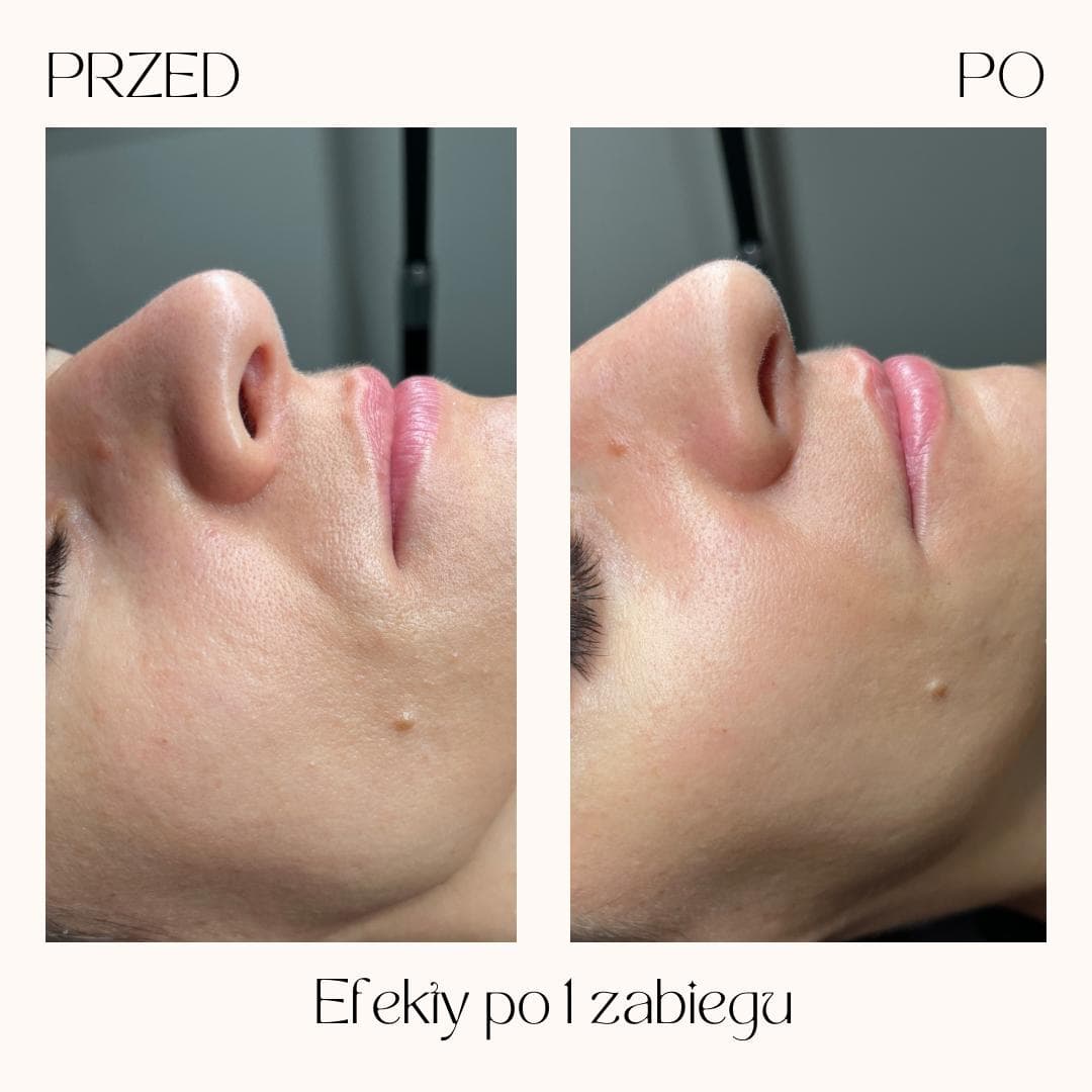 Efekty zabiegów Clean Skin — zdjęcie 7