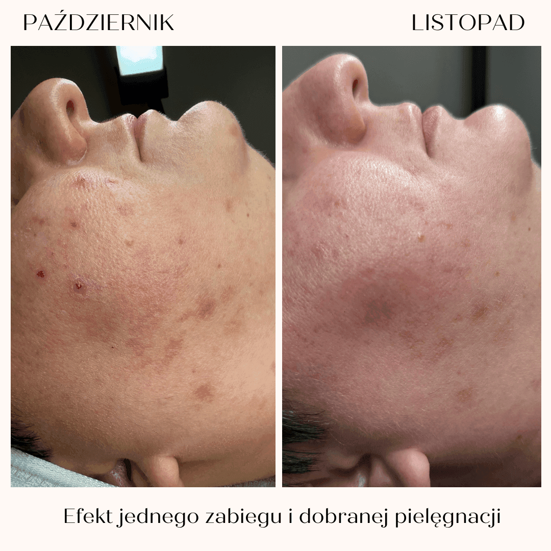 Holistyczna terapia skóry trądzikowej